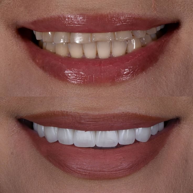 Shiny-Smile-Veneers-reviews-2