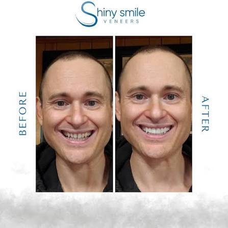 shiny-smile