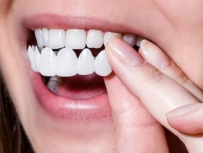 Shiny-Smile-Veneers-reviews-1