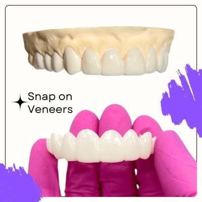 Shiny-Smile-Veneers-reviews-4